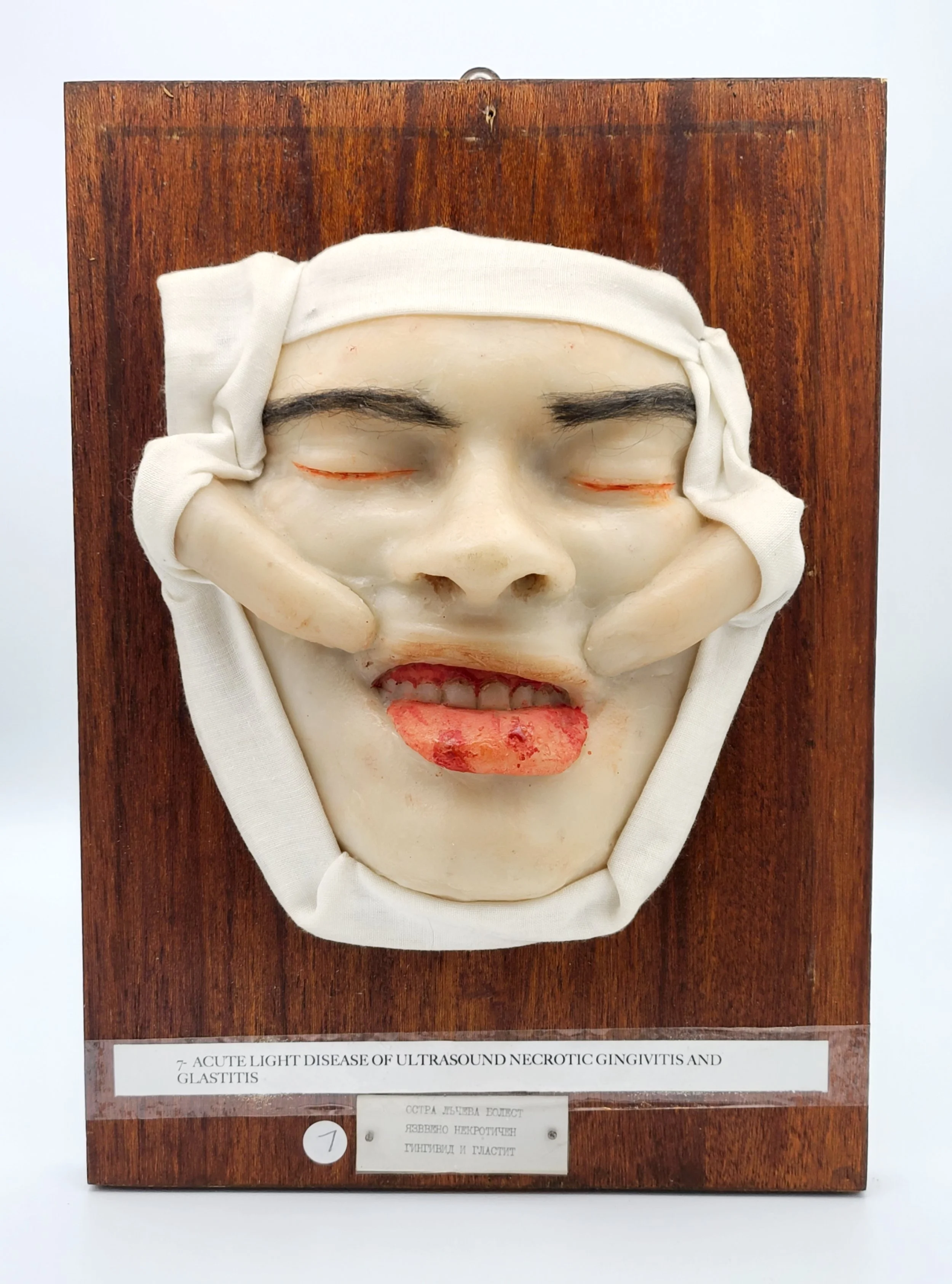 Wax moulage showing Gingivitis