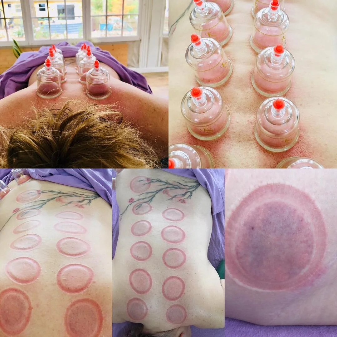 RNCY-cupping.jpg (Copy)