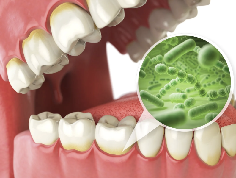 What is Dental Plaque and How Can it Affect My Teeth?