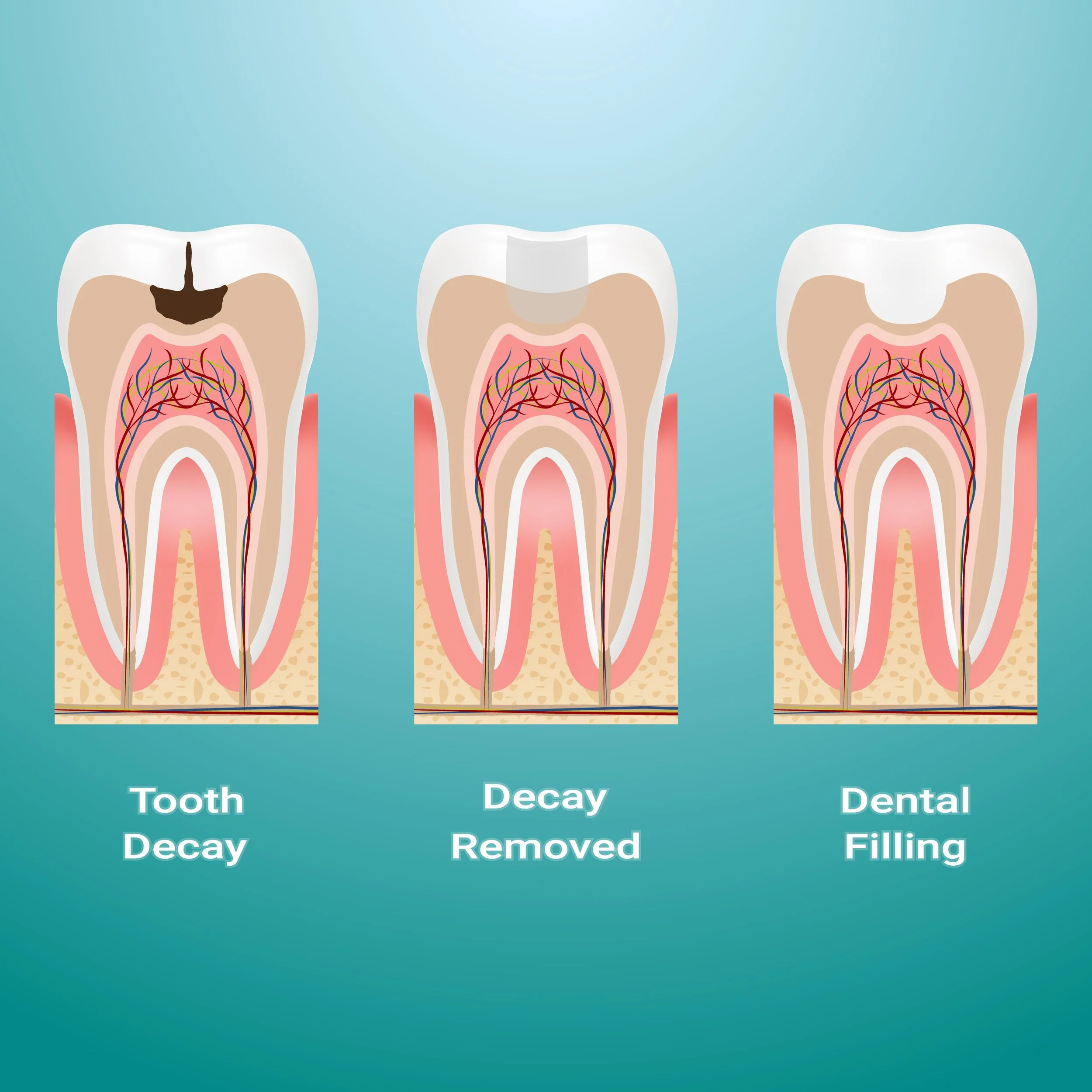 illustration of dental filling