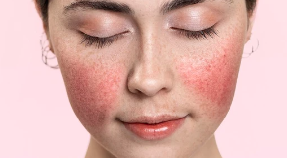 April marks Rosacea Awareness Month.