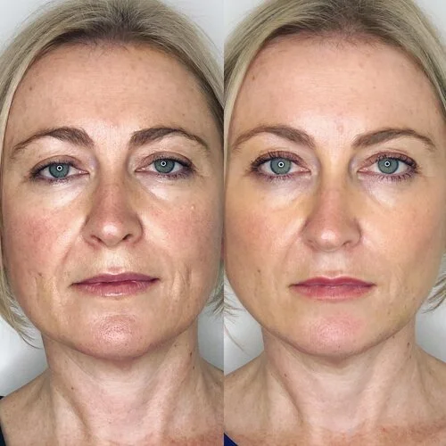 What is a thread lift and will one be good for me? — Central Wagga ...
