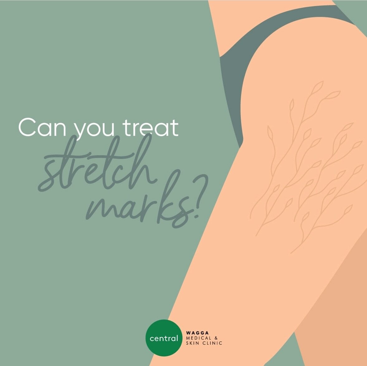 The short answer to a common question&hellip; Yes! 

Many of our patients are self-conscious about their stretch marks, which can be caused by various factors such as pregnancy, weight loss, weight gain, or genetics.

At our clinic, we offer several 