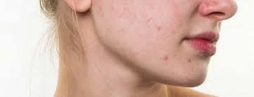 Understanding Acne: Causes, Treatment Options, and How We Can Help