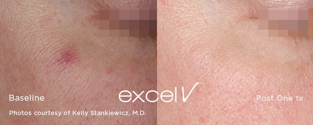 532_Angioma_3.jpg