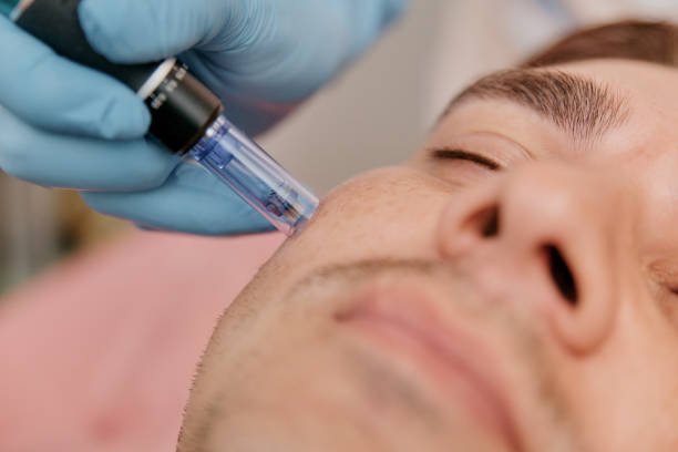 Unlocking the Beauty Benefits of the Vampire PRF Facial - Transform Your Skin Naturally!