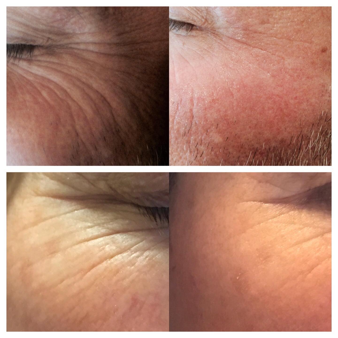 Microneedling is a skin treatment using a hand roller with tiny needles. It micro punctures the skin so that it thinks it&rsquo;s injured &amp; thus promotes cellular turnover of new skin &amp; more collagen.

The top pic of my work has been publishe