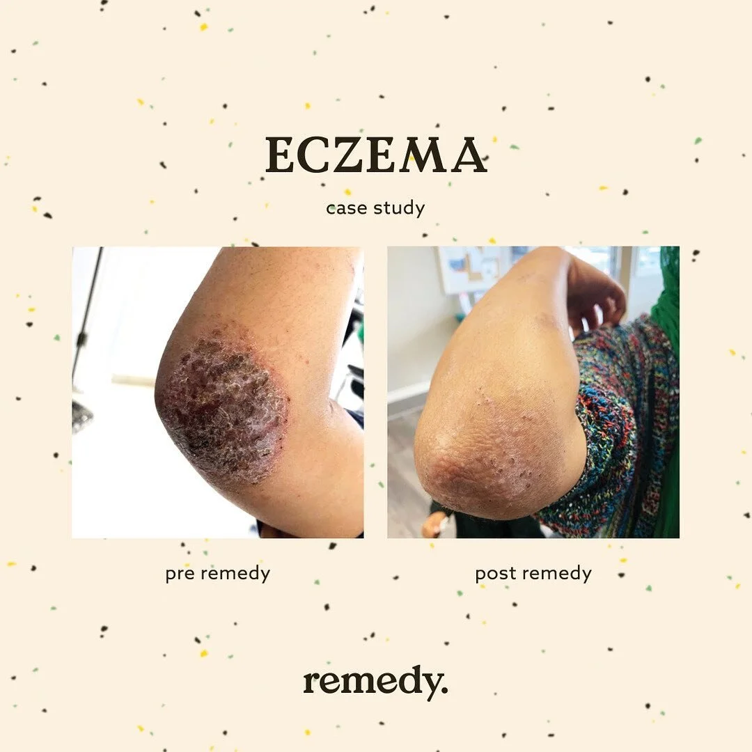 Eczema (atopic dermatitis) is painful, itchy and frustrating. Topical creams often provide momentary relief but many find the rash is only temporarily suppressed, coming back in the same place or elsewhere on the body. 
. 💪.
This client was treated 