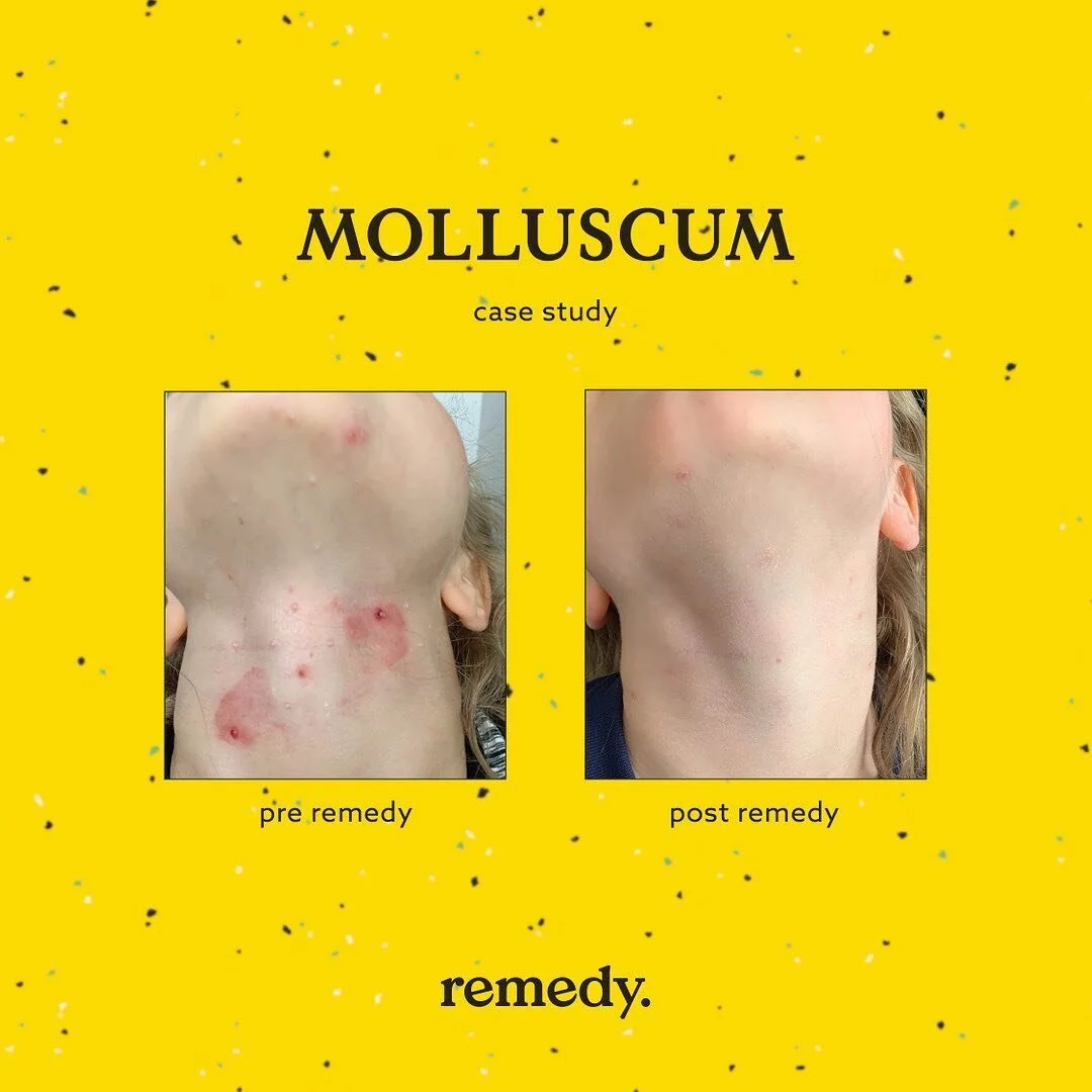 MOLLUSCUM CONTAGIOSUM is a viral skin infection (belonging to Pox-virus group) common amongst children and immunodeficient adults. It can itch, become inflamed, and in some cases infected. Molluscum can occur anywhere on the body, in this case it was