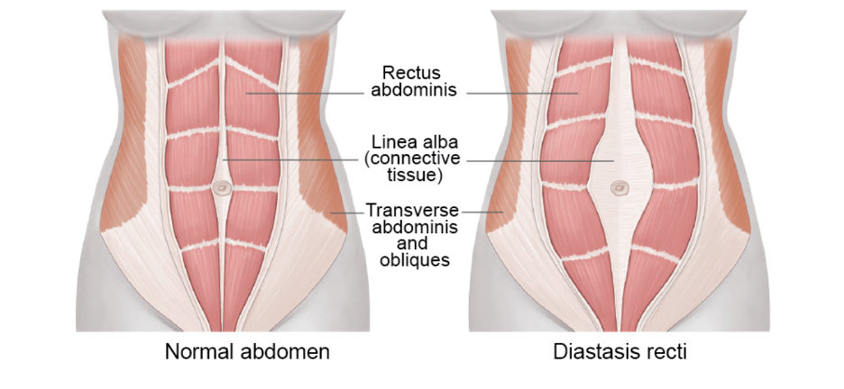Diastasis Recti: What It Is and How Physiotherapy Can Help — Corona ...