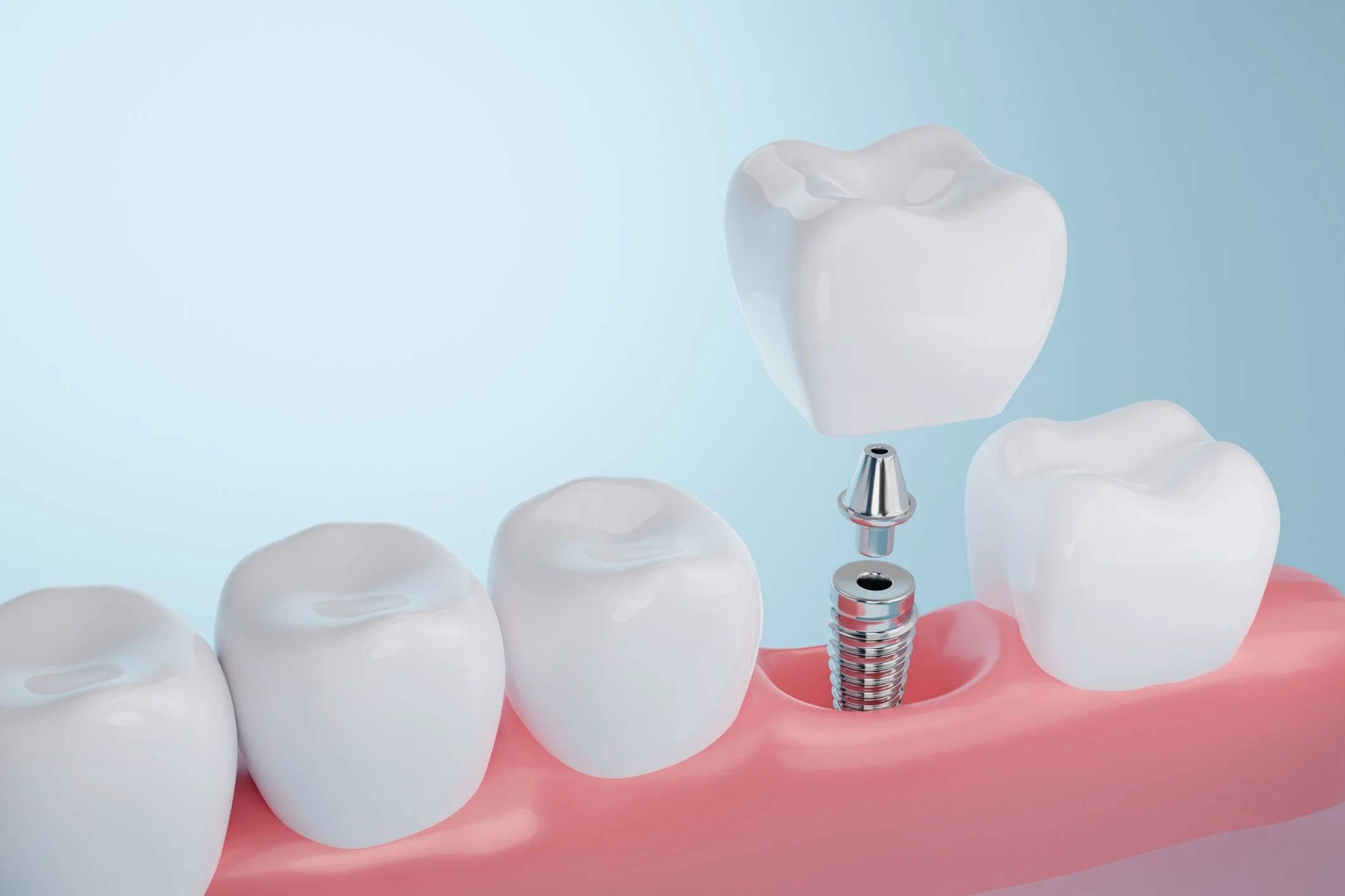 Animation of a dental implant process, showing a metal screw being inserted into the gum and a crown placed on top, with healthy teeth surrounding the implant.