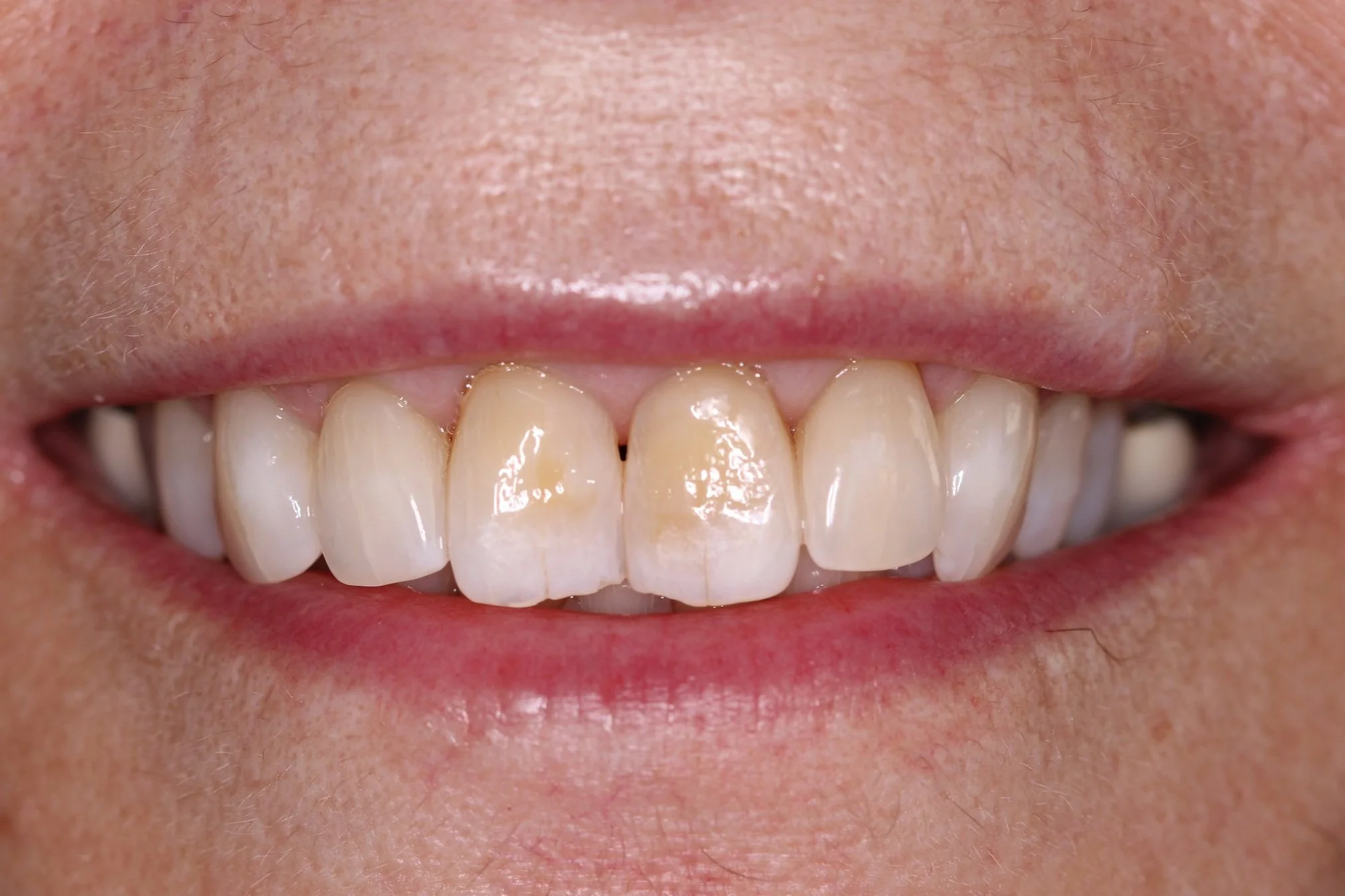 Front teeth prior to cosmetic bonding with dark stain and angulation.