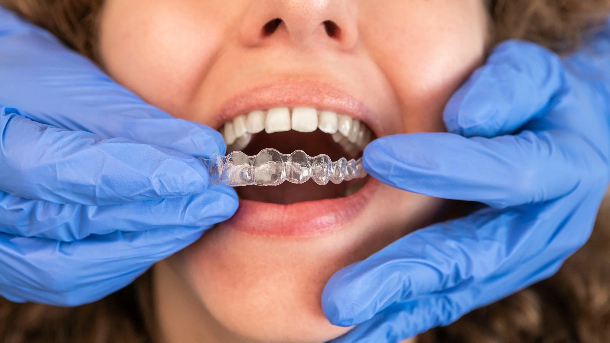 The Ultimate Guide to Invisalign in Boulder