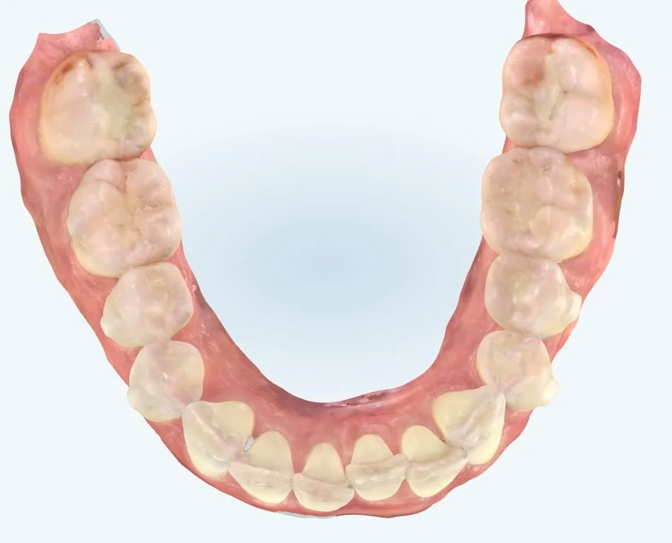 Before  Invisalign® treatment for a patient with lower anterior crowding.