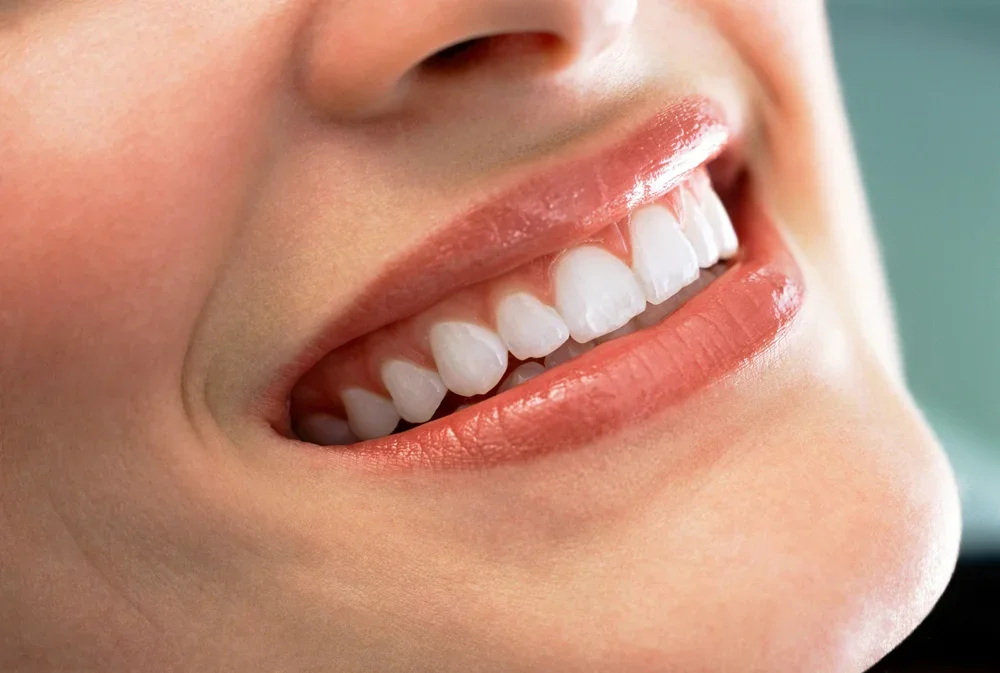 Beautiful white smile showcasing perfectly aligned dental veneers with natural appearance and healthy gums.