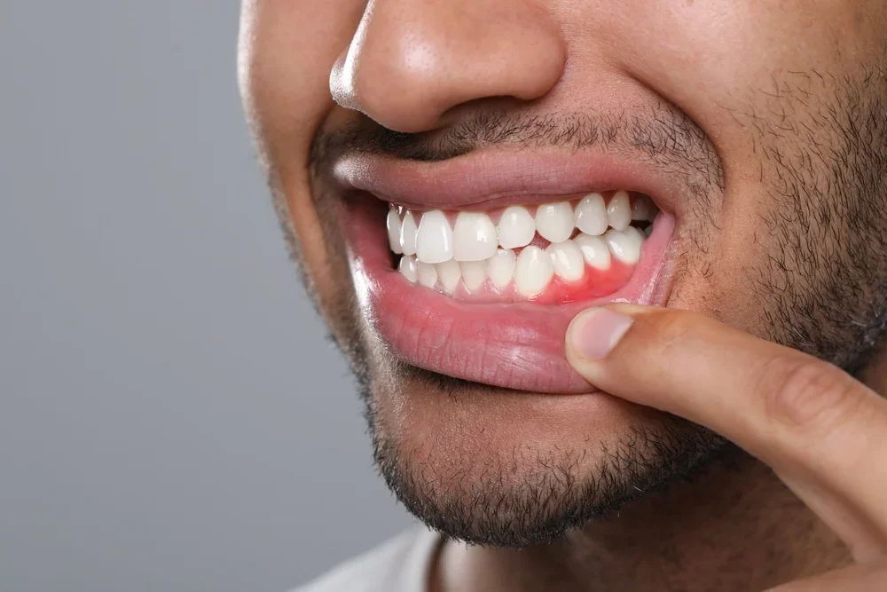 Close-up of man's bright white smile showing completed dental veneers with natural-looking results.