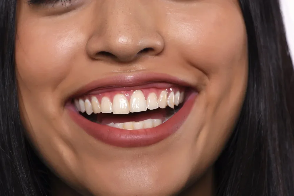 Close-up of woman's radiant smile displaying beautifully crafted dental veneers with natural tooth appearance.
