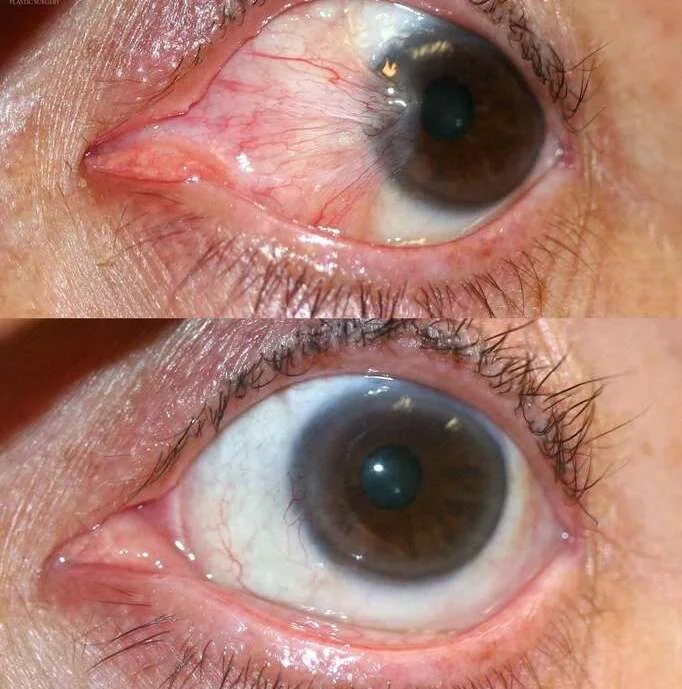 Ojo antes y después de la cirugía de carnosidad: arriba con carnosidad sobre la córnea y abajo con la superficie del ojo limpia