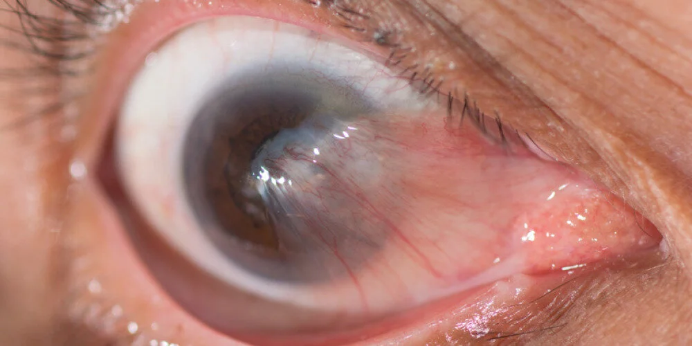 Primer plano de un ojo con una carnosidad avanzada que crece sobre la córnea hacia la pupila
