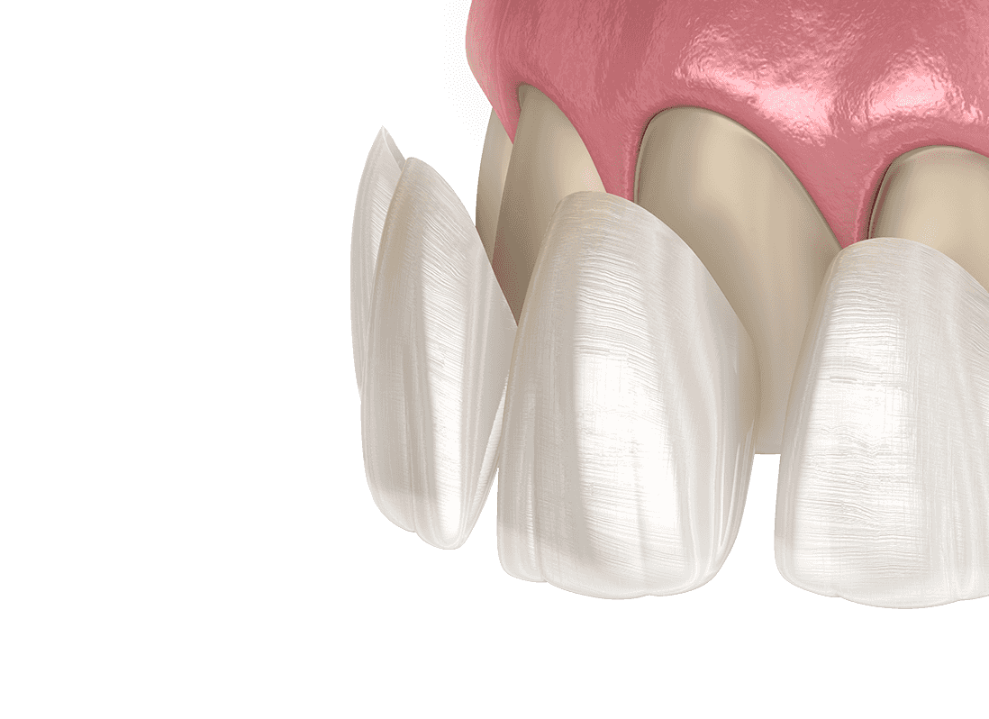 Beautiful Porcelain Veneers Memphis Cosmetic Dentistry Germantown