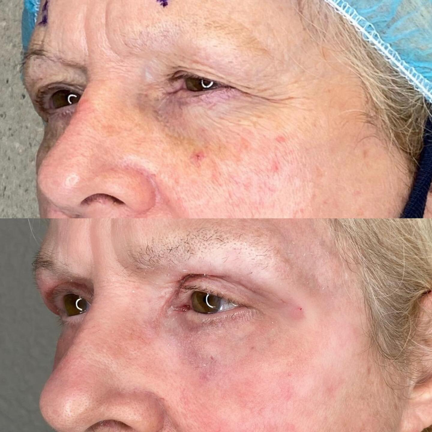 Bilateral upper lid blepharoplasty and brow pexy 10 day pos op - she just got her stitches out today! She will continue to look better and better in the next three months and she continues to heal 💙

She also had periocular CO2 laser resurfacing to 