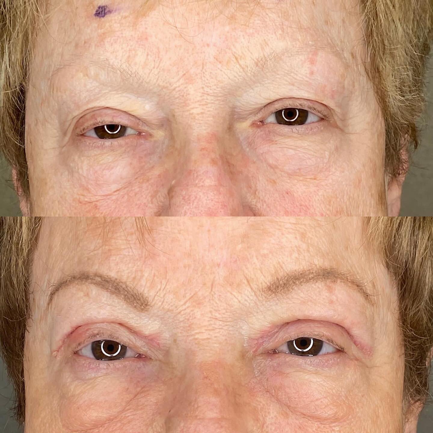 Right upper lid ptosis repair. One month after surgery at Perich Eye Center. Do you like the results? #transformationtuesday 

Dr. Tanya Perich 
Perich Eye Center
Main location and surgery center: 2020 Seven Springs Blvd. New Port Richey 34655, Fl.
⁠