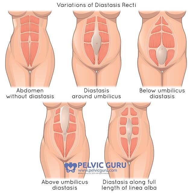 Diastasis Rectus Abdominus (DRA or DR) Separation of Abdominal