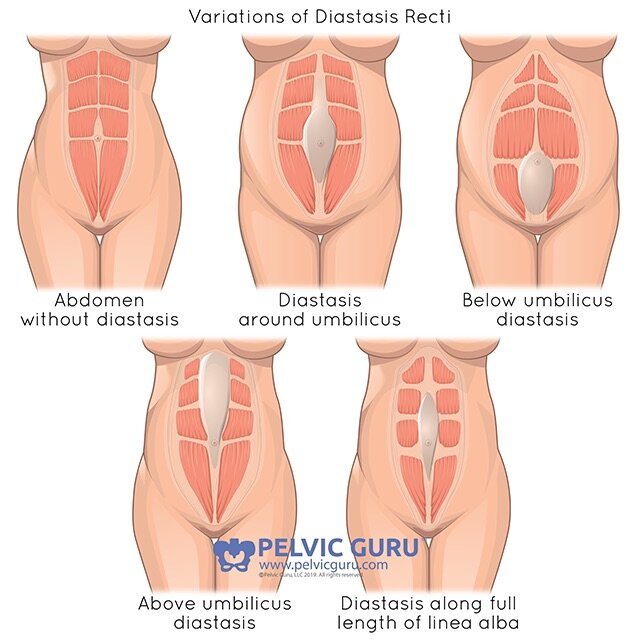 Diastasis Rectus Abdominus (DRA or DR) Separation of Abdominal Muscles —  APHysio, LLC - Physical Therapy and Wellness