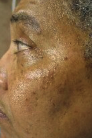 pigmented-lesions2.png
