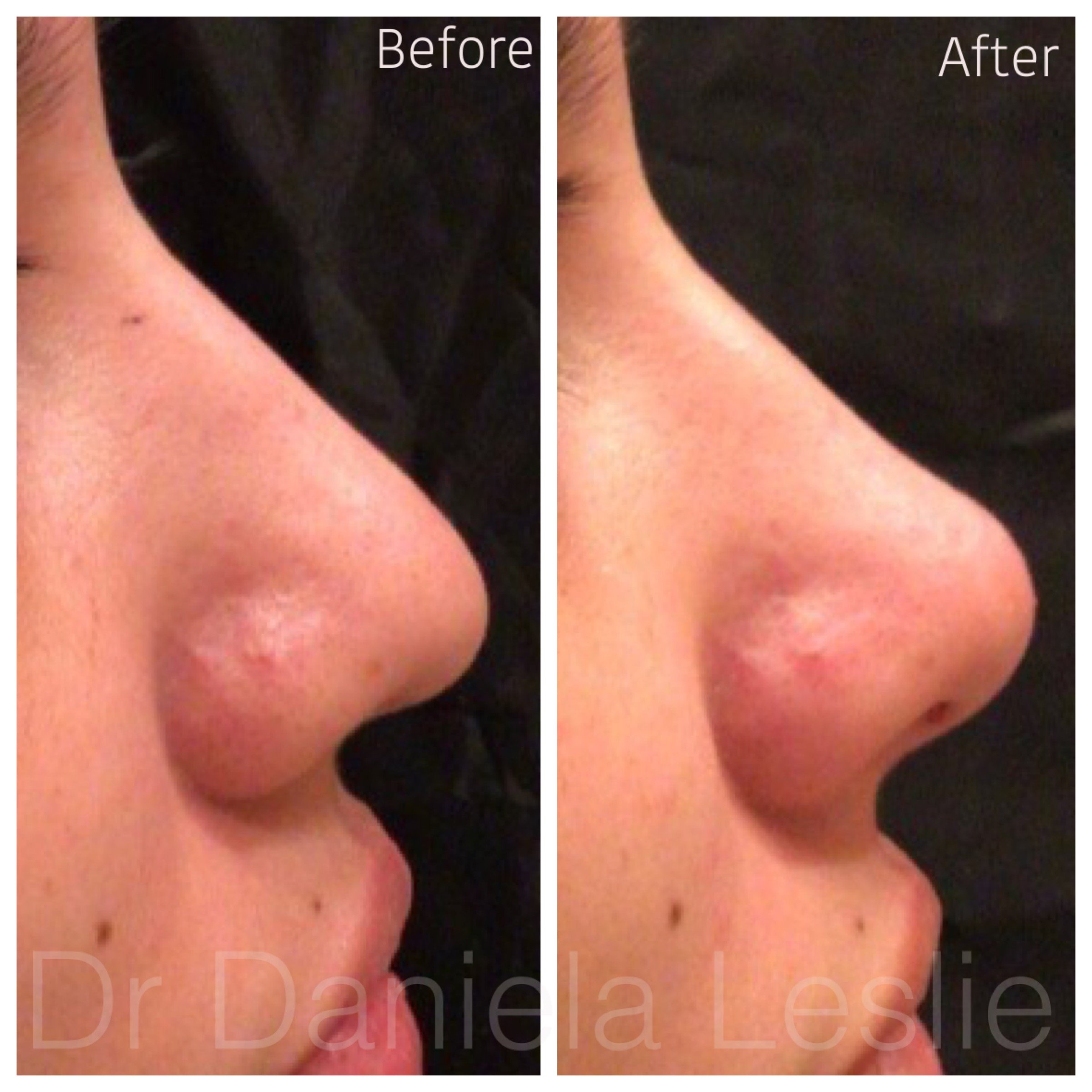 Liquid Rhinoplasty & Thread Lift — Aesthetic Genesis