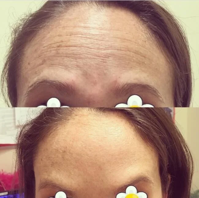 Botox 2.jpg