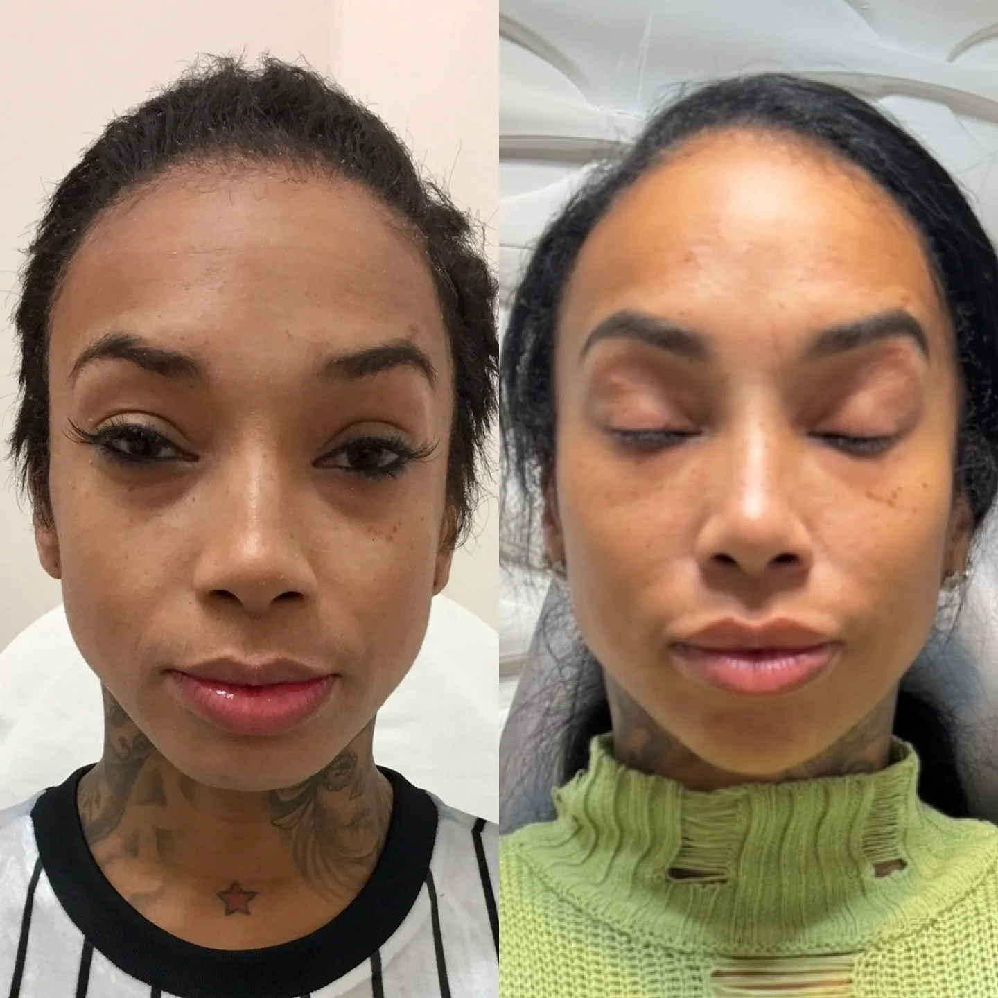 💉 Facial harmonization is achieved through strategy, not spontaneity.
The left photo (2017) shows the starting point of a gradual, medically guided approach. Consistency with one injector allows for precise balance, natural symmetry, and safe, anato