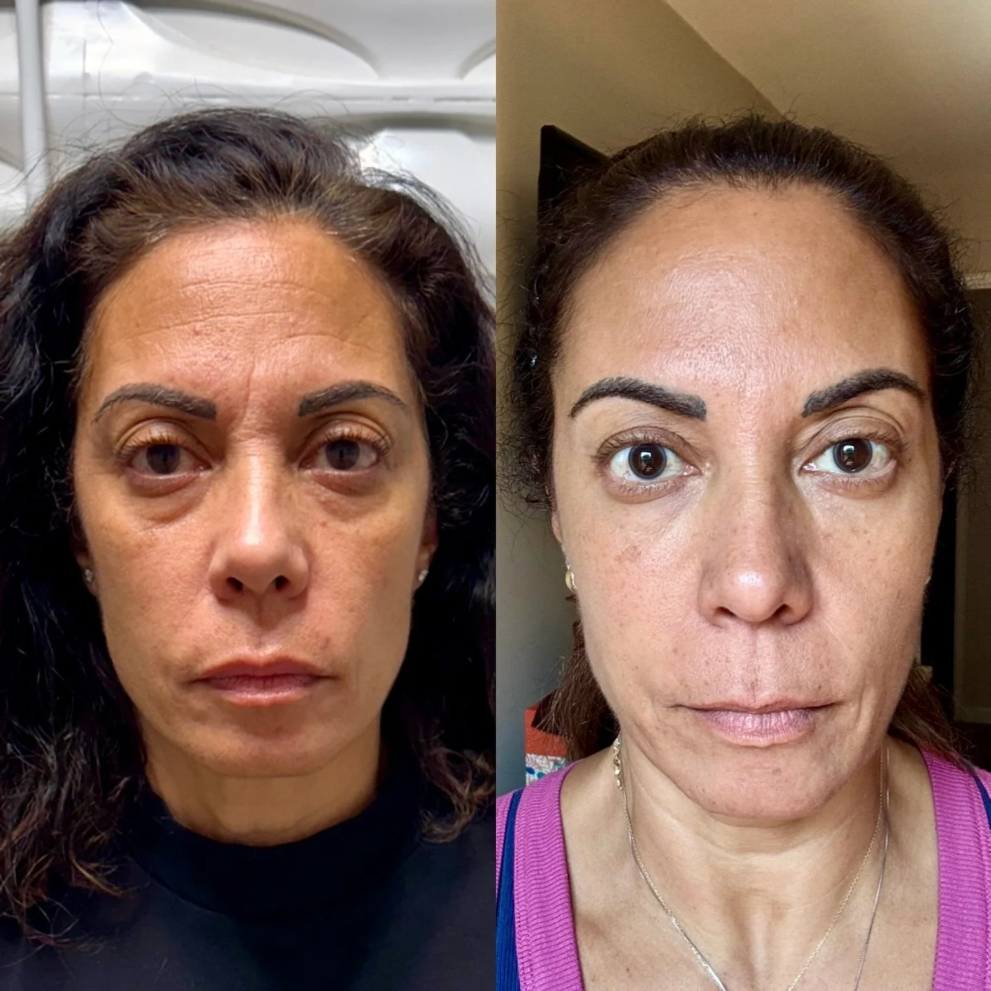 ✨ Perfectly placed neurotoxin and filler = subtle polish, refreshed radiance, and a naturally balanced look. It&rsquo;s the art of enhancing what&rsquo;s already beautiful&mdash;never overdone, always refined. 💉💫

#RefreshedAndPolished #SubtleEnhan