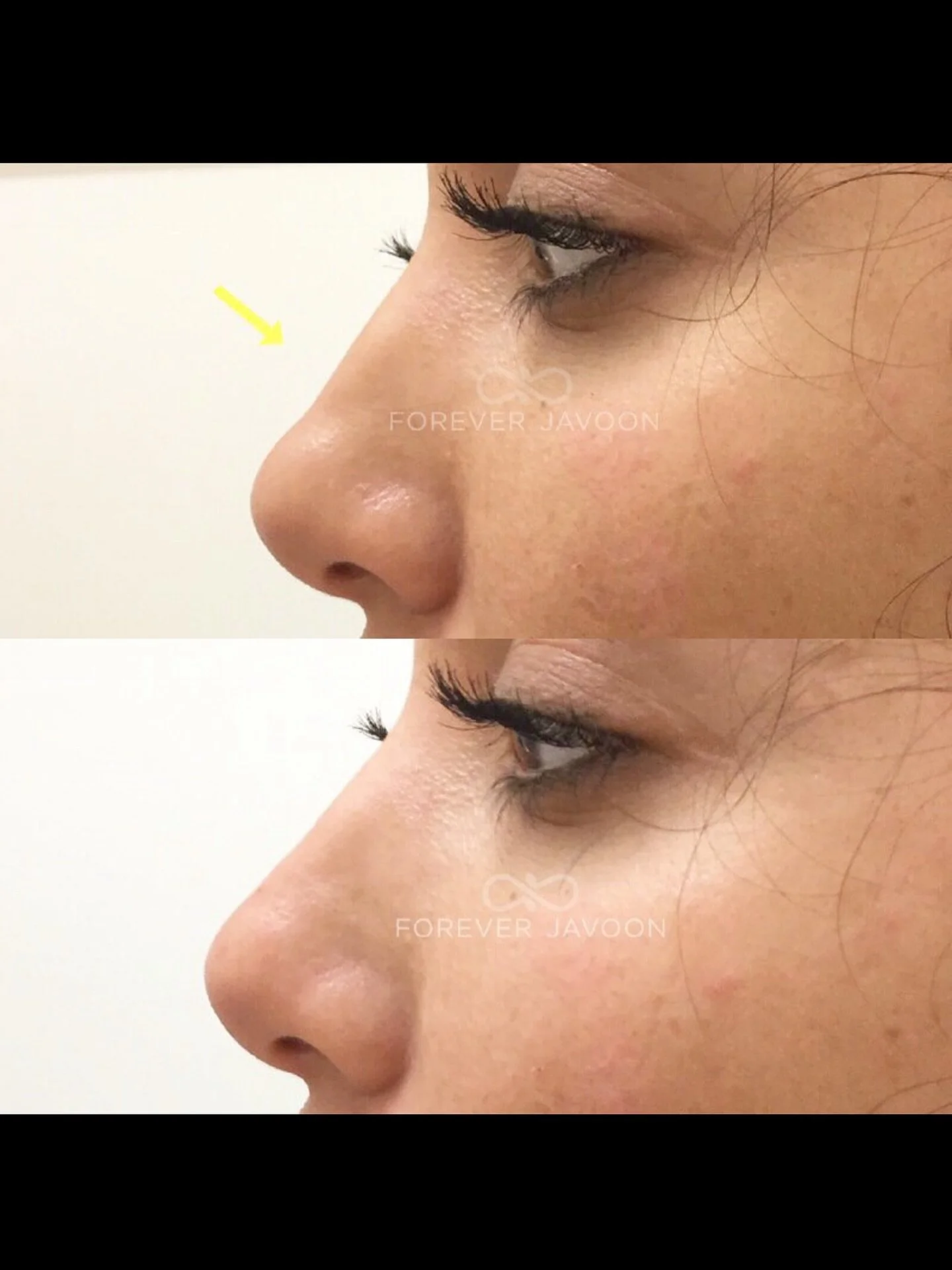 ✨Refine without surgery ✨
Filler to the nose is the perfect way to smooth out minor bumps, lift the tip, and create a straighter, more balanced profile &mdash; all with zero downtime.
A few expertly placed injections = natural, seamless results that 
