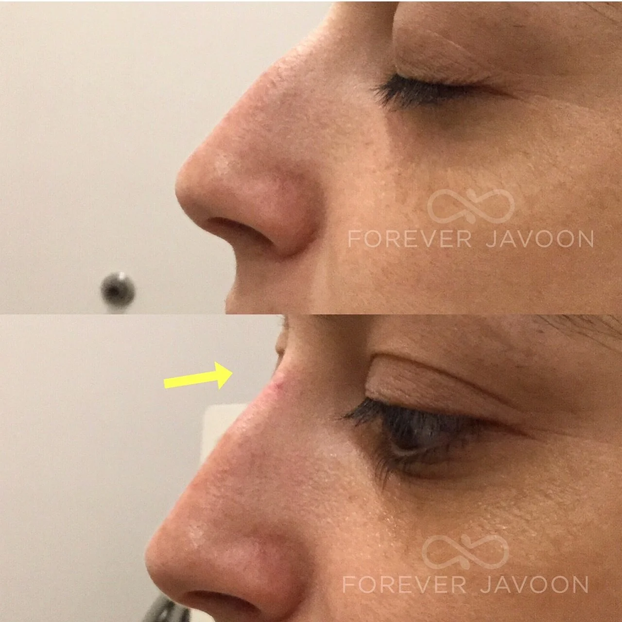 ✨ Smooth, balanced, and beautiful &mdash; non-surgical filler can soften the appearance of a dorsal hump and create a straighter, more refined nose profile without surgery. Quick treatment, natural results, and no downtime. 💉👃

#NonSurgicalNoseJob 