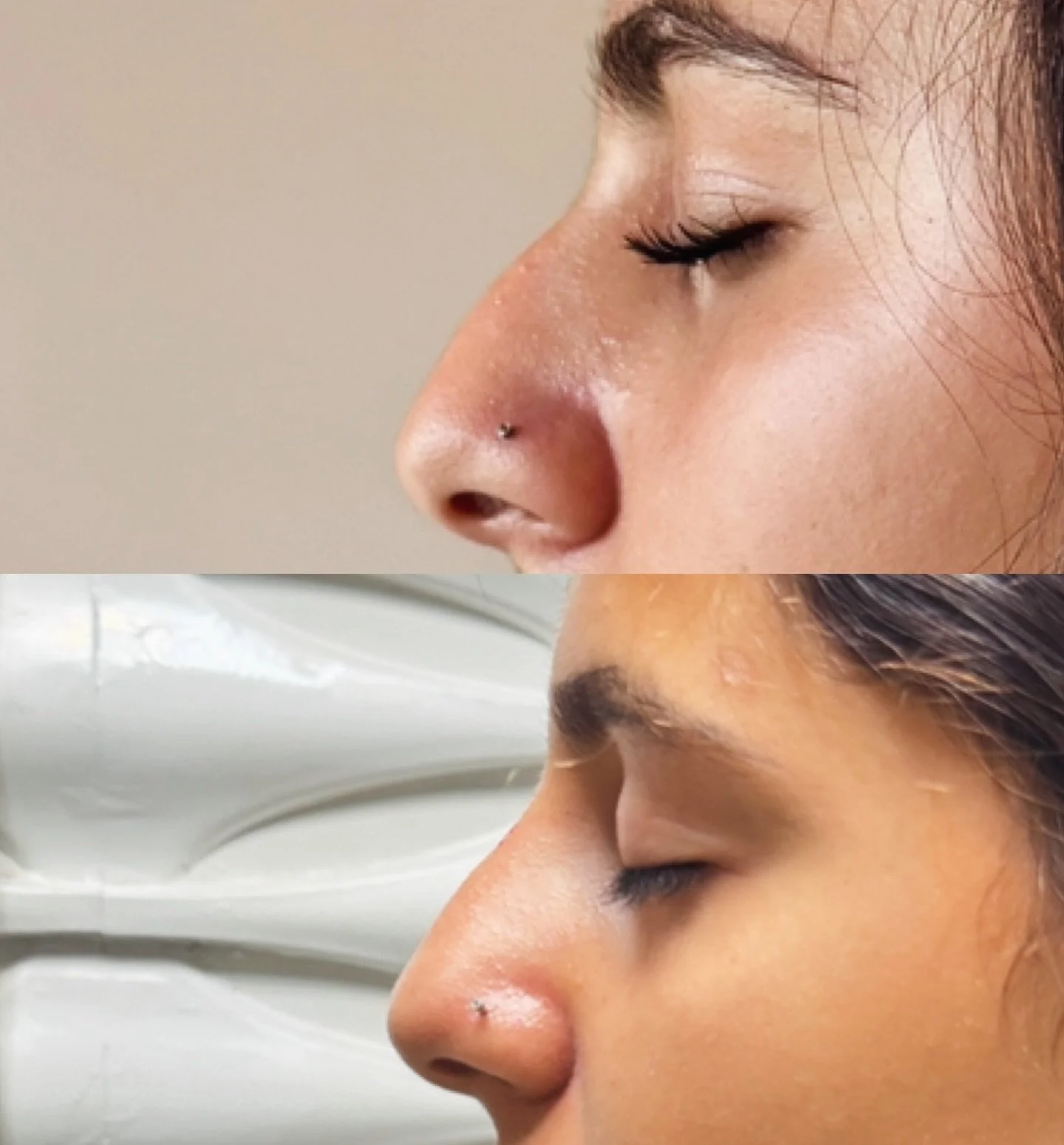 ✨Refine your profile without surgery✨
Filler to the nose can smooth out a dorsal hump and create a straighter, more balanced look &mdash; subtle changes that make a big impact. 💉👃

#NonsurgicalRhinoplasty #LiquidNoseJob #ProfilePerfection #FacialBa