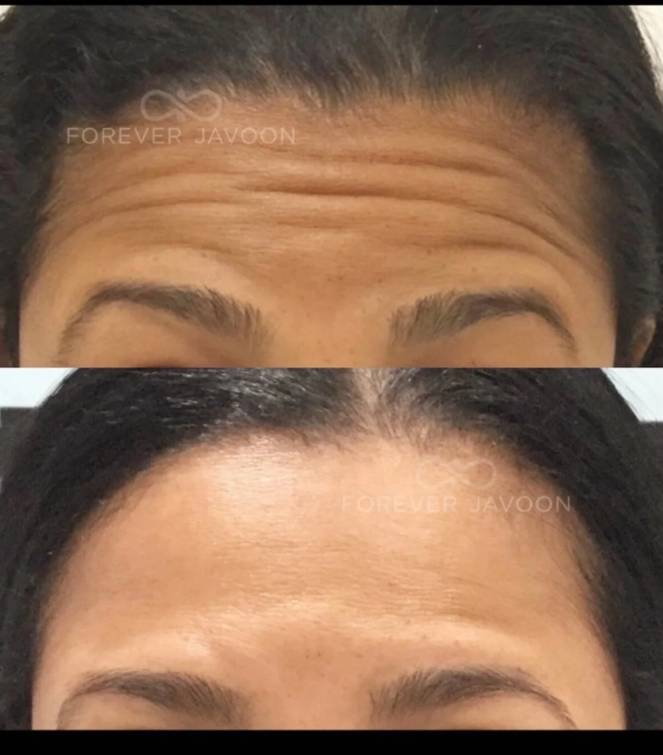 ✨ Smooth now, prevent later ✨
Fine lines and wrinkles don&rsquo;t have to define your skin&rsquo;s story. Starting neurotoxin early is like hitting pause on those deep-set lines before they even have a chance to form. Prevent, preserve, and keep your