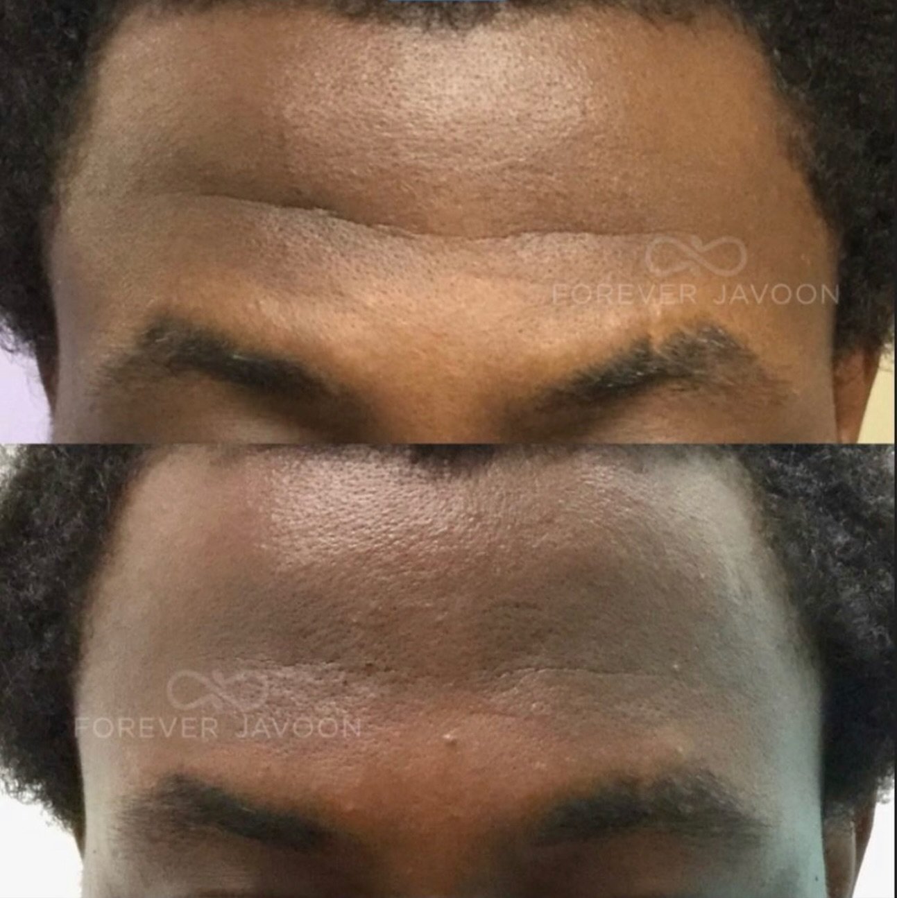 ✨ When filler + neurotoxin work together, the results are smoother, softer, and more natural. By addressing deeper, indented areas with filler and refining movement with neurotoxin, we create balance and harmony that one treatment alone can&rsquo;t a