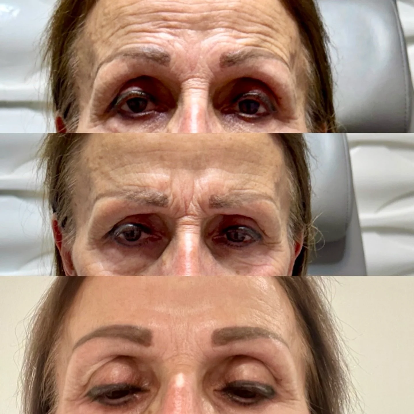 ✨When neurotoxin is placed with precision, the result is a natural lift and smooth, refreshed appearance&mdash;never frozen, always flawless. It&rsquo;s all about knowing where, how much, and why. ✨

#SmoothNotFrozen #SubtleLift #ExpertInjector #Wrin