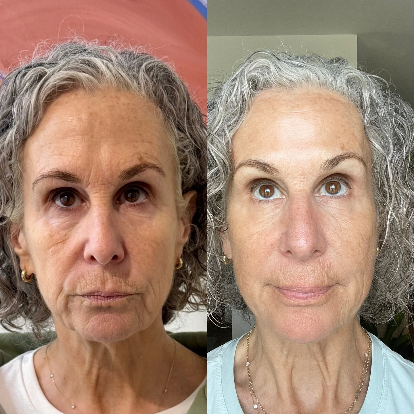 ✨Lifted. Smoothed. Refreshed.✨
After just 3 sessions of CoolPeel&reg; CO₂ and expertly placed neurotoxin, this beauty has brighter, smoother skin and a subtle lift that looks completely natural.

CoolPeel works to resurface and rebuild collagen, whil