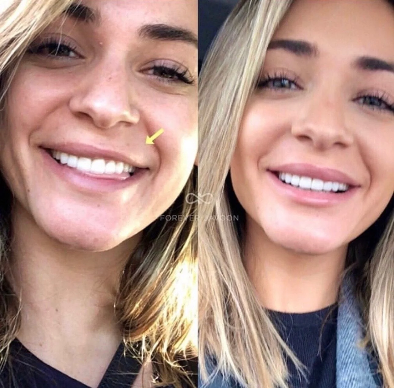 Neurotoxins aren&rsquo;t just for smoothing lines &mdash; they can also lift and subtly balance the lips for a naturally fuller look. A few precisely placed units can relax downward pull and even out asymmetry without adding volume 💋✨&rdquo;
#LipBot