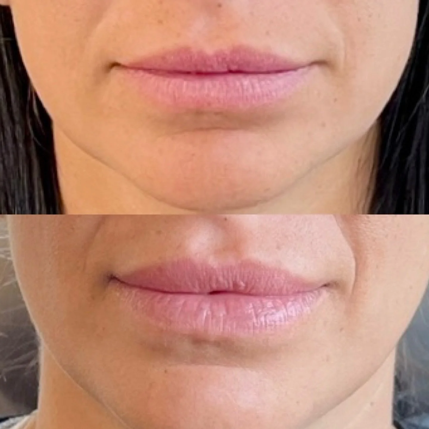 A little neurotoxin goes a long way. The lip flip gently rolls the top lip outward&mdash;something filler can&rsquo;t replicate&mdash;giving that soft, balanced lift. ✨
#LipFlip #BotoxLips #NaturalEnhancement #AestheticInjector #ForeverJavoon