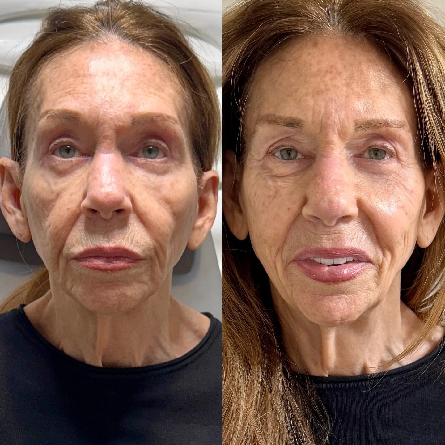 A gentle lift. A natural glow. ✨
When filler is placed with intention and skill, you don&rsquo;t look &ldquo;done&rdquo; &mdash; you just look elevated.
Trust the artistry.
#ForeverJavoon

#NaturalFiller #FacialBalancing #LiftedLook #AestheticExpert 