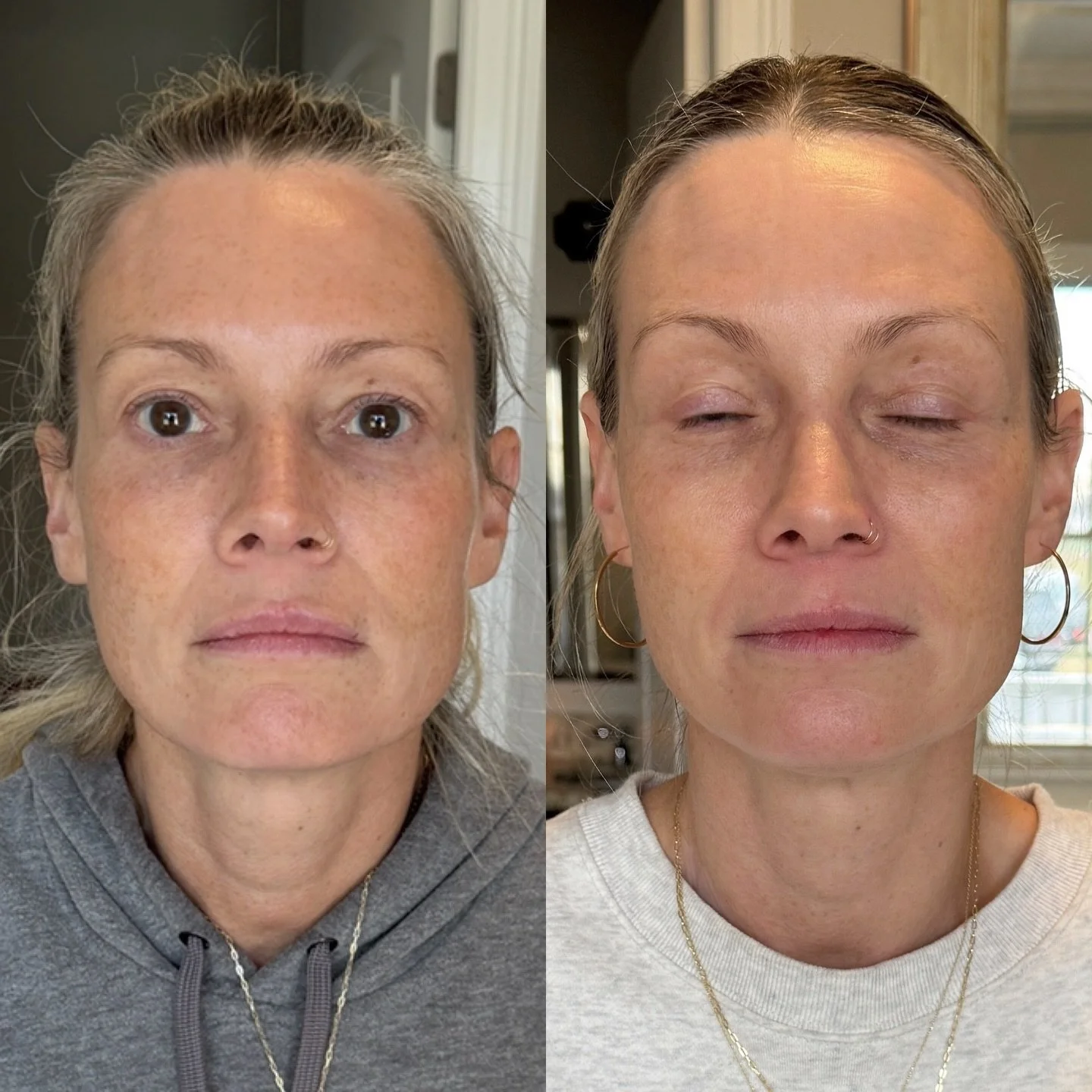 On the right is what biostimulation looks like.
The after photo shows results following Sculptra&mdash;a collagen-stimulating injectable that works gradually to restore structure, firmness, and skin quality from within.

No overfilling.
No frozen loo