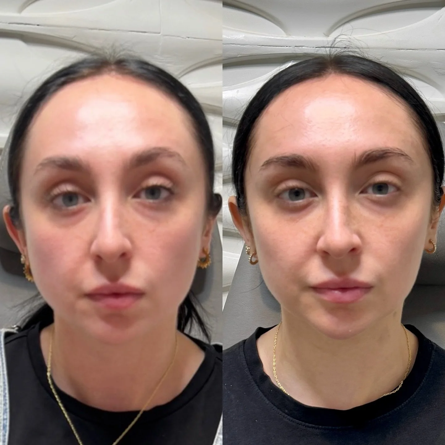 Softly sculpted, never frozen ✨
Expertly placed filler and neurotoxin refined the jawline and enhanced facial symmetry&mdash;creating a naturally slim, contoured look.

#RefinedResults #JawlineSlimming #FacialSculpting #BeautyInBalance #ForeverJavoon