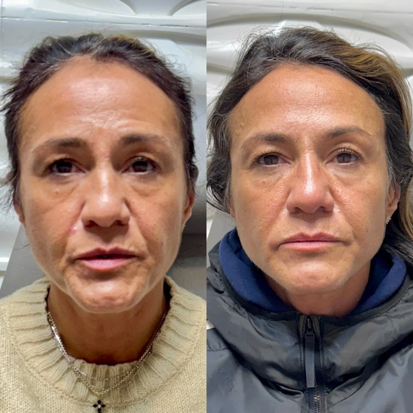 Perfectly placed neurotoxin + subtle filler + CO₂ resurfacing = a lifted, refined, naturally radiant result ✨
When technique, timing, and artistry align, your skin doesn&rsquo;t look done &mdash; it just looks undeniably refreshed.

Less volume. More