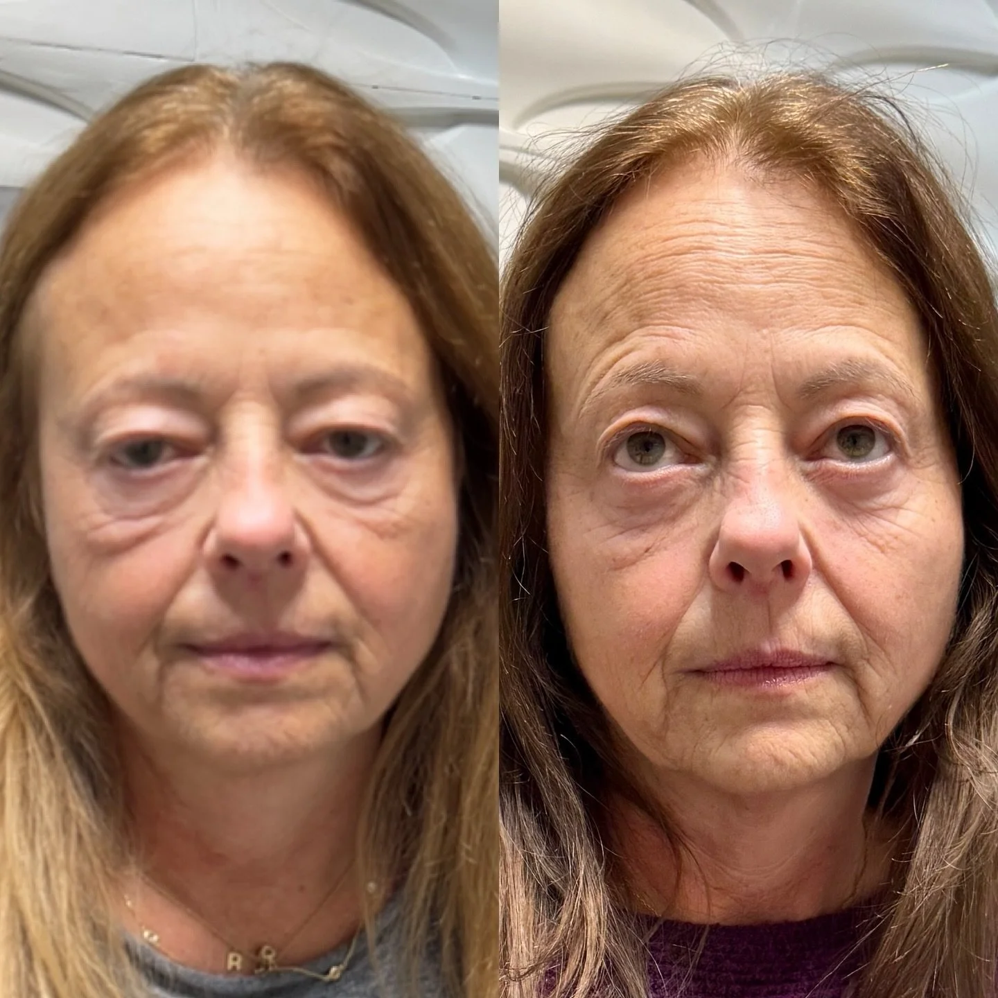 Anyone can inject filler.
Not everyone understands facial anatomy, vector support, and restraint.

Proper placement = natural lift, longevity, and results that age beautifully.

#AnatomyFirst #InjectorExpert #NaturalLift #AestheticArt #ForeverJavoon