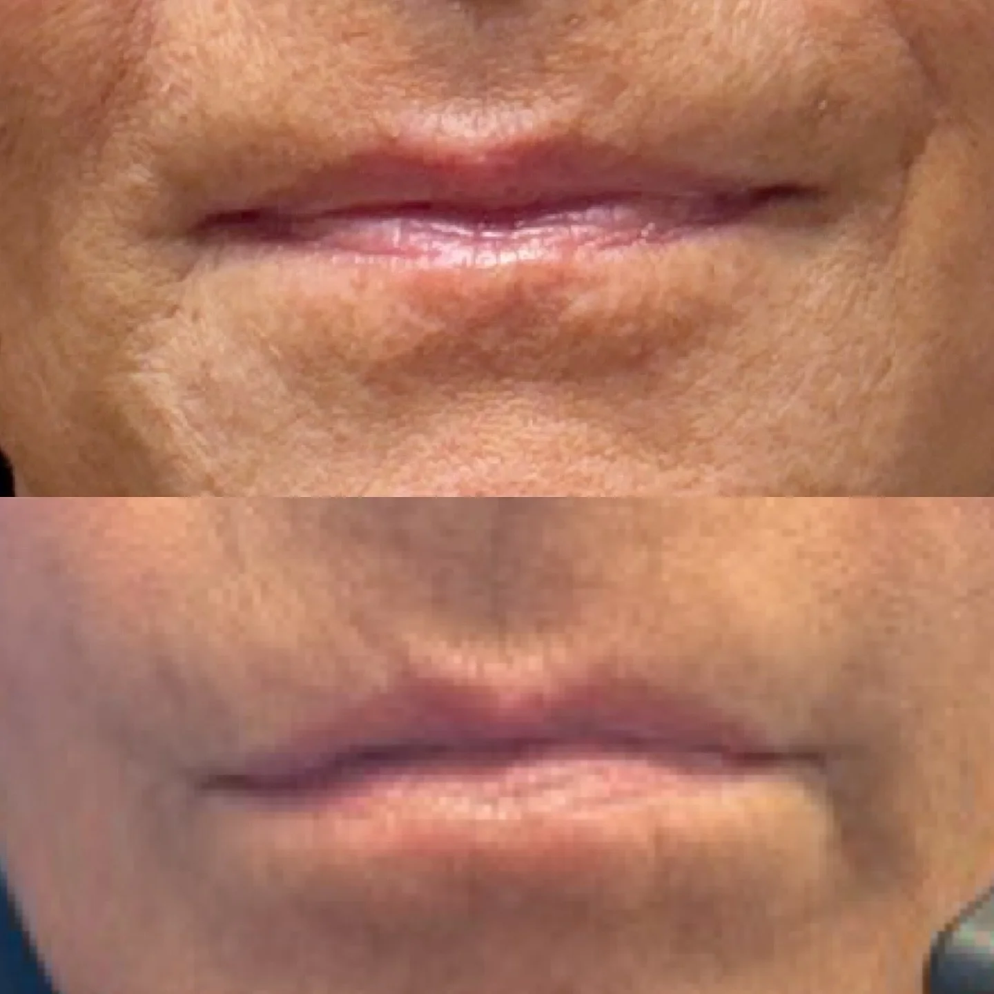 ✨A tiny touch of Botox to the bottom lip can make a big difference &mdash; relaxing the muscle to gently flip out the lip and create a more balanced, even smile. Subtle, precise, and completely natural-looking. 💋

#LipFlip #BotoxBeauty #FacialBalanc