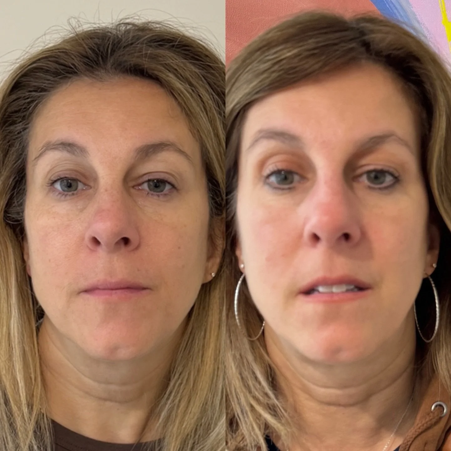 Tear troughs don&rsquo;t always need filler&mdash;especially when puffiness or malar edema is involved.

CoolPeel is one of my favorite ways to gently resurface and tighten the delicate under-eye area, helping to smooth texture, improve skin quality,