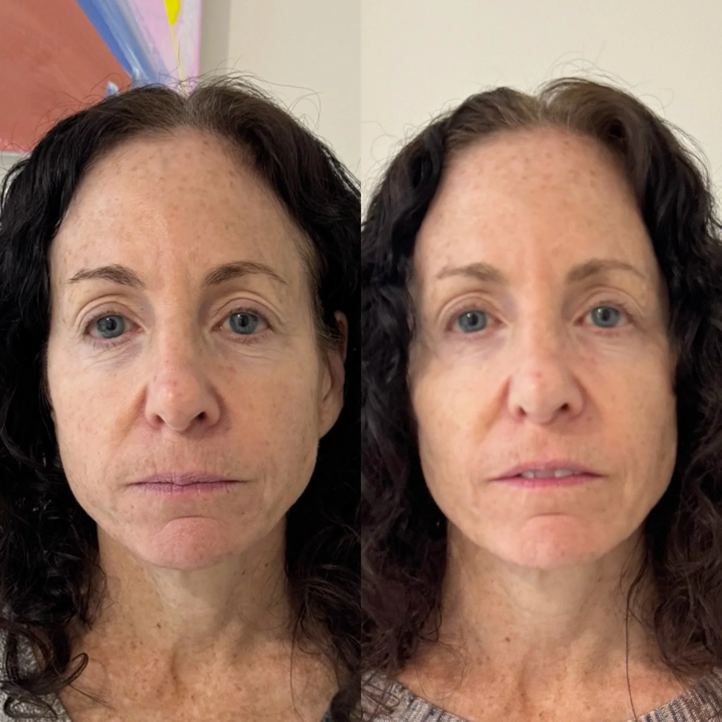 After on the right ✨ (before her 3rd CoolPeel)

Smoother texture, more even skin tone, and a visibly lifted, tighter look&mdash;without aggressive downtime. This is what consistent, collagen-stimulating treatments can do over time.

The goal isn&rsqu
